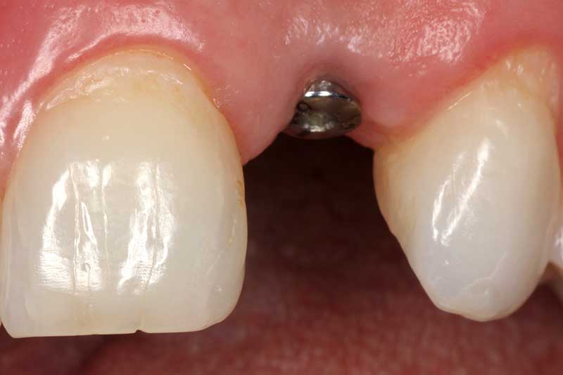 How a a dental implant looks in the mouth of an actual patient of Dr. Mitchell Kim's. 