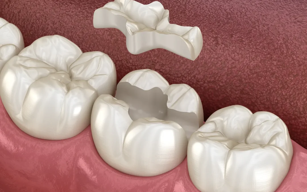 Single-Visit Dentistry: The Power of CEREC for Porcelain Inlays and Onlays