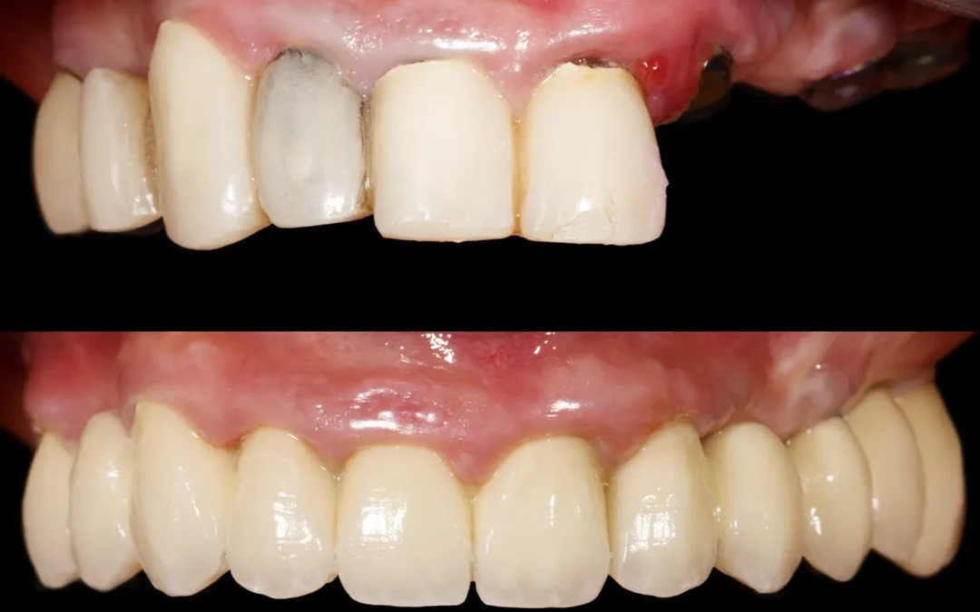 Full Mouth Reconstruction vs. Smile Makeover: What Richardson Patients Should Know